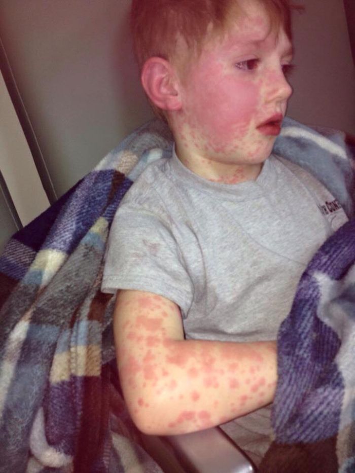 Child Complained Of Poison Oak But It Was Stevens Johnson Syndrome (1)