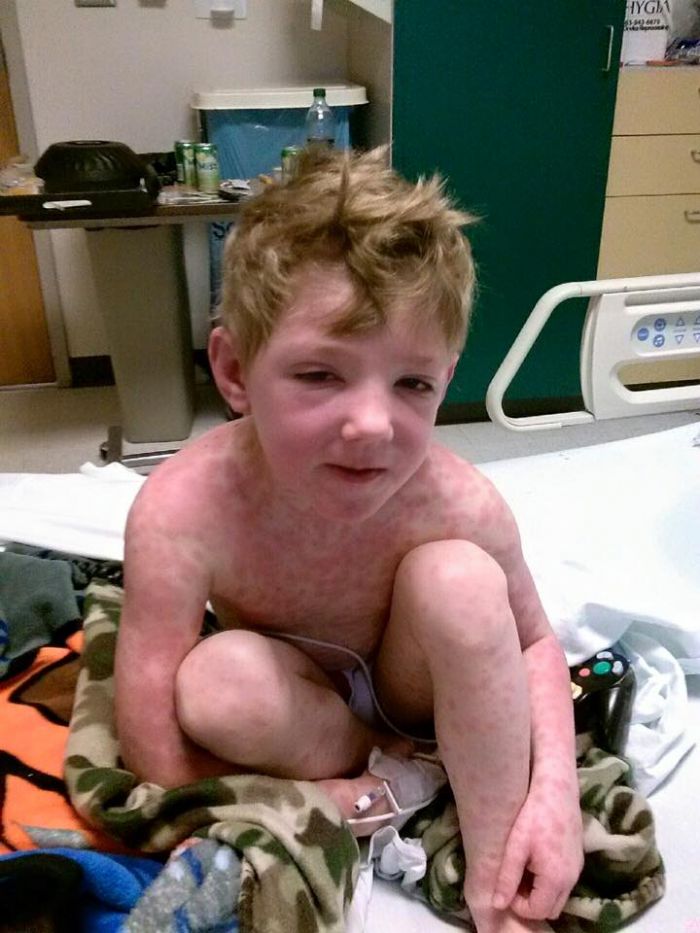Child Complained Of Poison Oak But It Was Stevens Johnson Syndrome (4)
