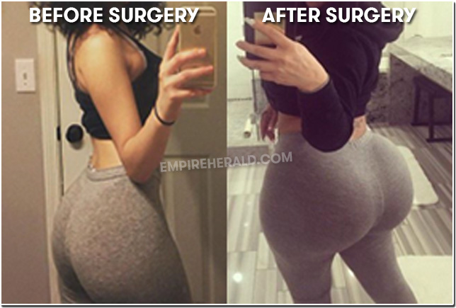 before-after-implants